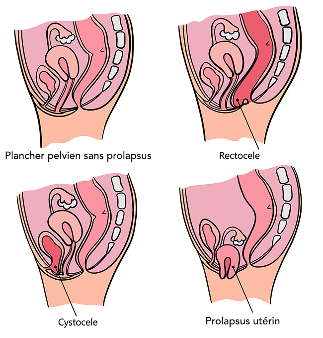 prolapsus génital